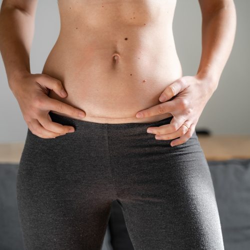 Woman with c section scar on her abdomen